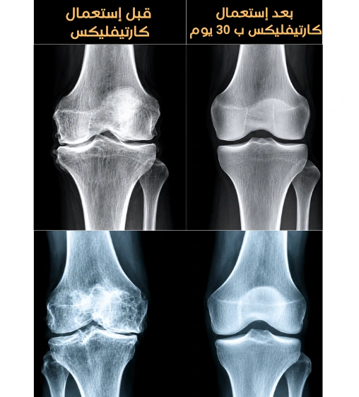 CartiFlex Before After X-Ray